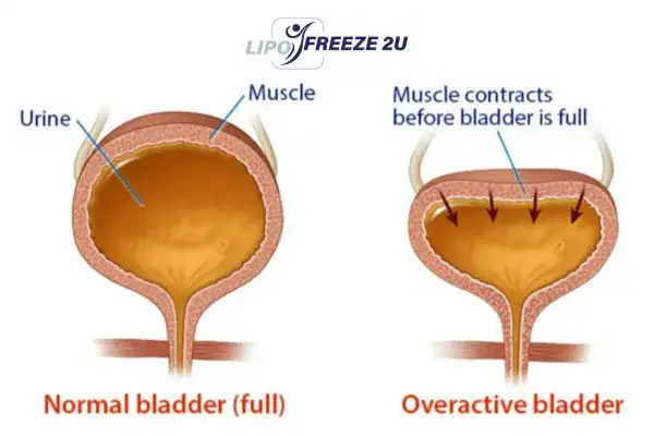 diagram of overactive bladder treatment Irvine