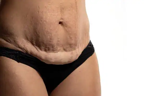 loose skin after weight loss injections Irvine