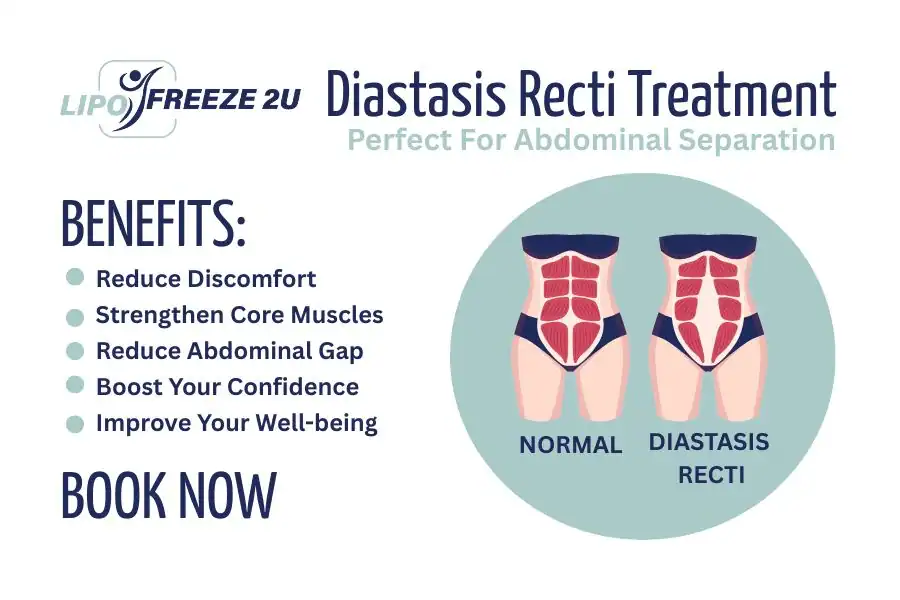 Benefits of body toning treatment Irvine for Diastasis recti