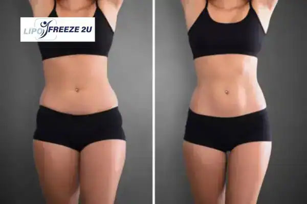 How Can LIPO FREEZE 2U Support Your Post-Pregnancy Body Recovery Irvine?
