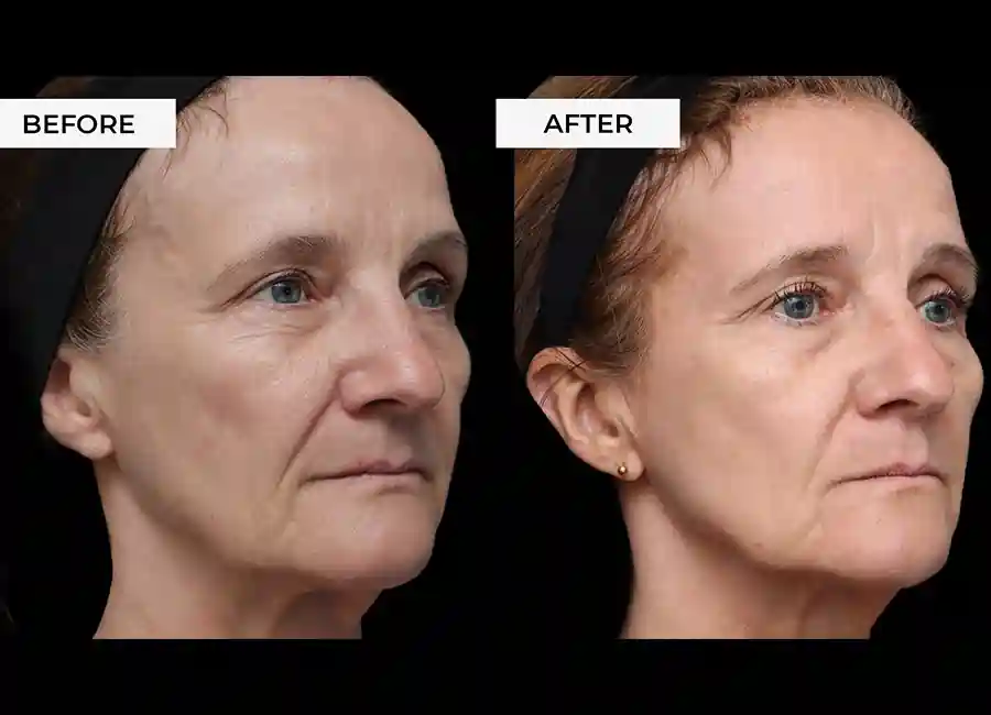 How Many RF Microneedling Sessions Will You Need to See a Difference Irvine?