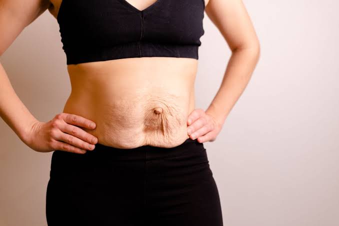 Is Surgery Really the Only Way to Repair Diastasis Recti Irvine?