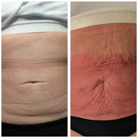 How Does RF Microneedling Improve Crepey, Thin and Uneven Skin Texture Irvine?