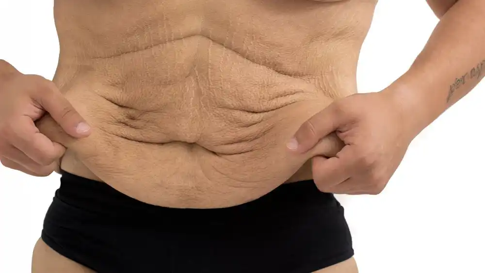 Why Does Weight Loss Medication Leave Some People With Loose or Sagging Skin Irvine?